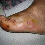 piede_diabetico-02