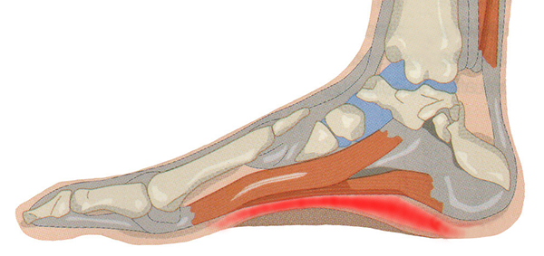 Fascite plantare