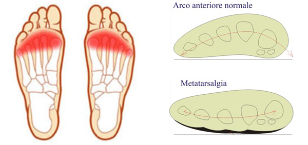 Metatarsalgia